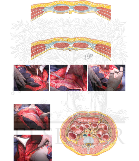 Transversus abdominis release (TAR)