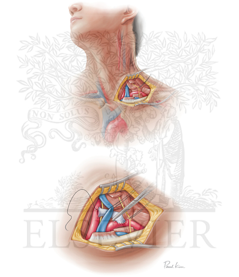Carotid subclavian bypass
