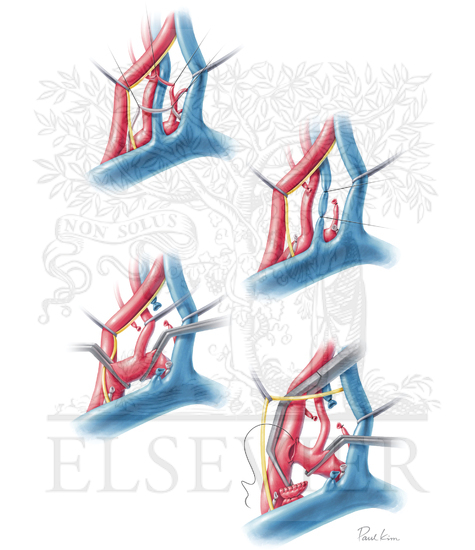 Subclavian-to-carotid transposition