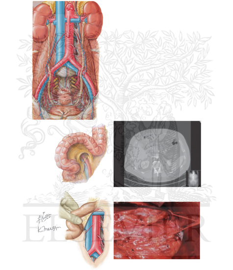 Aortic and iliac arterial relationships with retroperitoneal structures