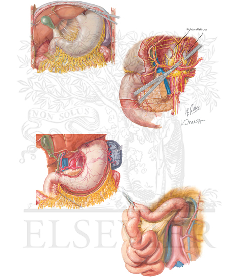 Surgical exposure of supraceliac aorta, superior mesenteric artery (SMA), and
reconstruction