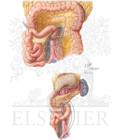 Retrograde mesenteric bypass
