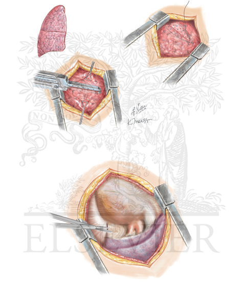 Pulmonary injuries