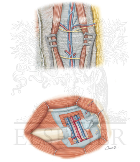 DIEP flap vascular pedicle and recipient vessel dissection