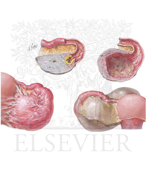 Progression of tubo-ovarian abscesses