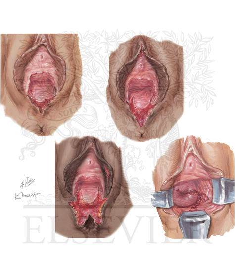 Obstetric lacerations (first, second, and third degrees)