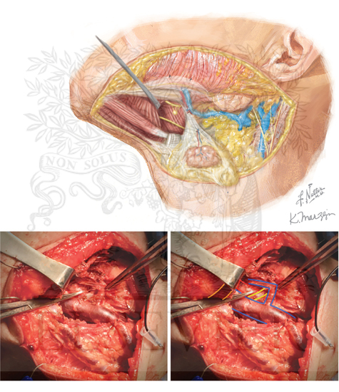 Hypoglossal nerve and level IIa dissection