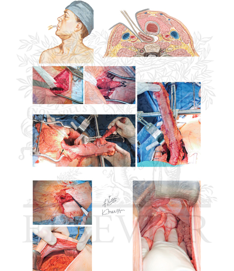 Transhiatal esophagectomy