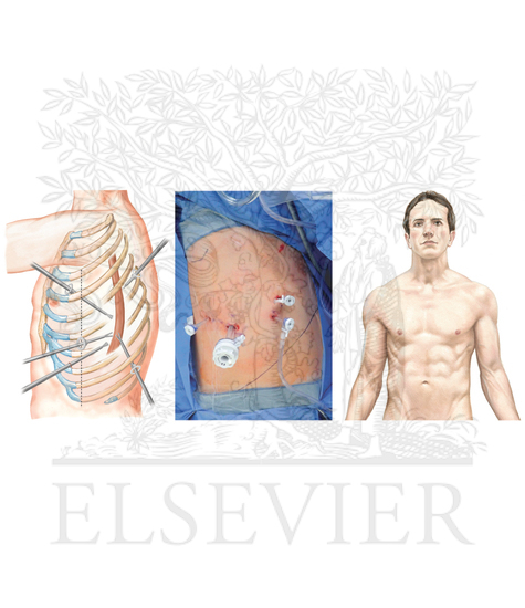 Intrathoracic