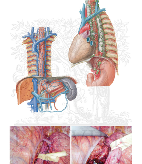Modified McKeown (three-hole)
esophagectomy