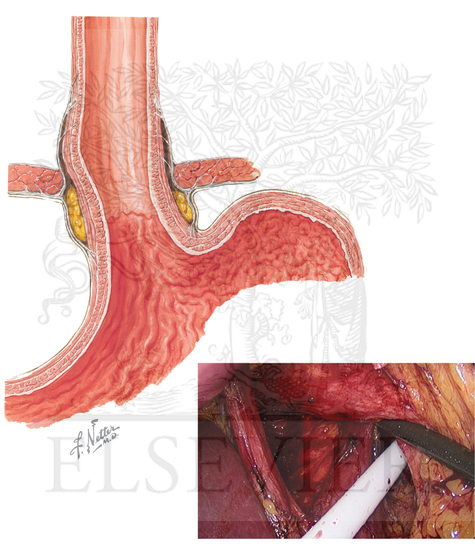 Phrenoesophageal ligament