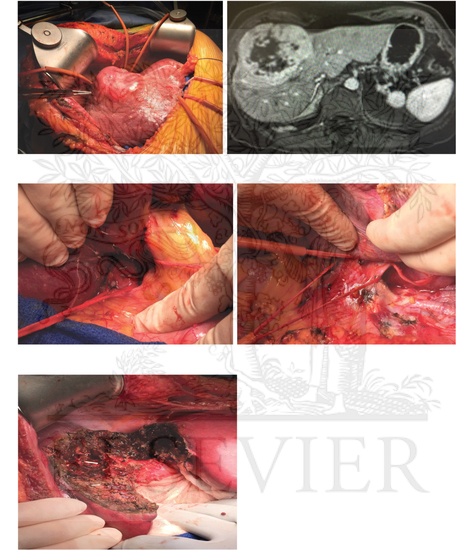 Left hepatectomy