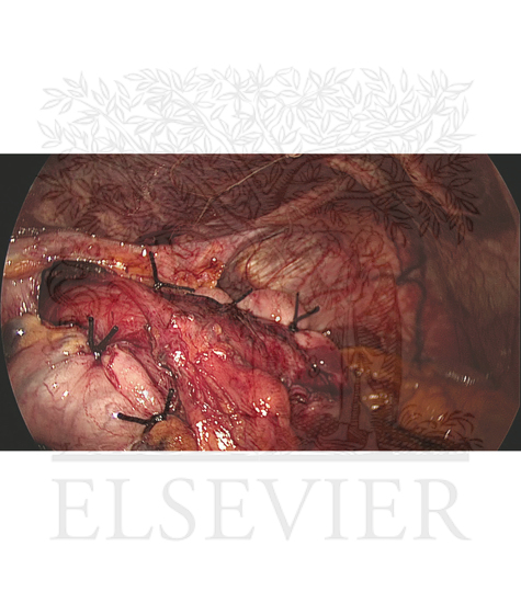 Watermarked preview of unlabeled image: Intraoperative picture of a completed Toupet fundoplication after Heller myotomy