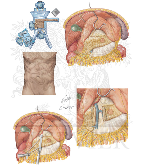 Laparoscopic distal pancreatectomy