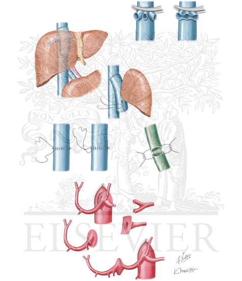 Piggyback technique, portal vein, and hepatic artery