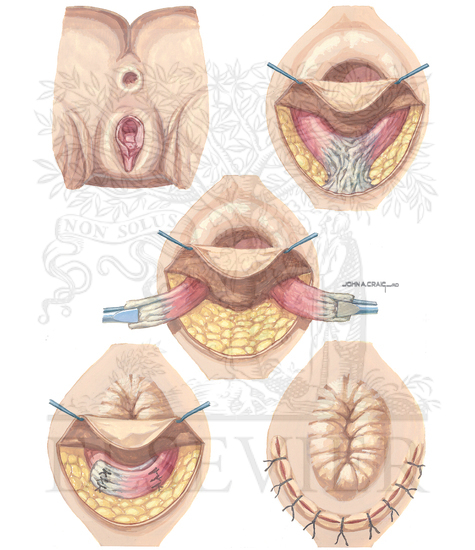 Watermarked preview of unlabeled image: Overlapping sphincter repair is performed by dissection of the sphincter muscles withoverlapping sutured repair