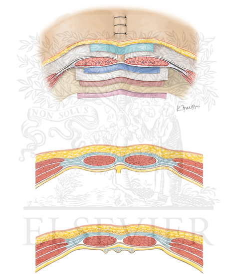 Retromuscular mesh placement and Rives-Stoppa
cephalad and caudad arcuate lines