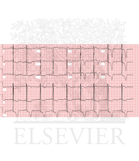 ECG from a patient with hypertrophic cardiomyopathy demonstrates deep T-wave inversion and ST-segment depression predominantly in the lateral precordial leads V4-V6