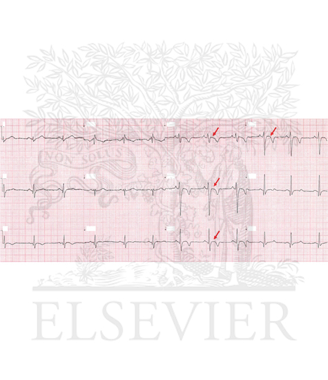 Watermarked preview of unlabeled image: ECG with anterior T-wave inversions (V1-V4) preceded by a nonelevated J-point and ST segment (red arrows), suggestive of AC