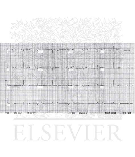 ECG from a 17-year-old female with a QTc of 525 ms and subsequently diagnosed with LQT1 syndrome