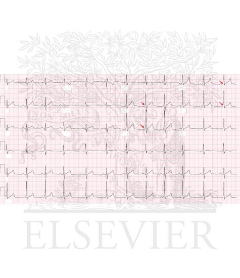 ECG demonstrating the classic findings of Wolff-Parkinson-White pattern with a short PR interval (<120 ms), delta wave with slurred QRS upstroke (red arrows), and prolonged QRS (>120 ms)