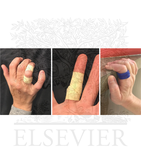 Taping and rigid splinting for pulley injuries