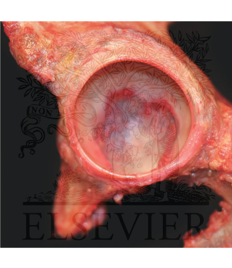 Cadaveric image of a left hip demonstrating osseous and soft tissue (including the labrum and the transverse ligament) components of the acetabulum