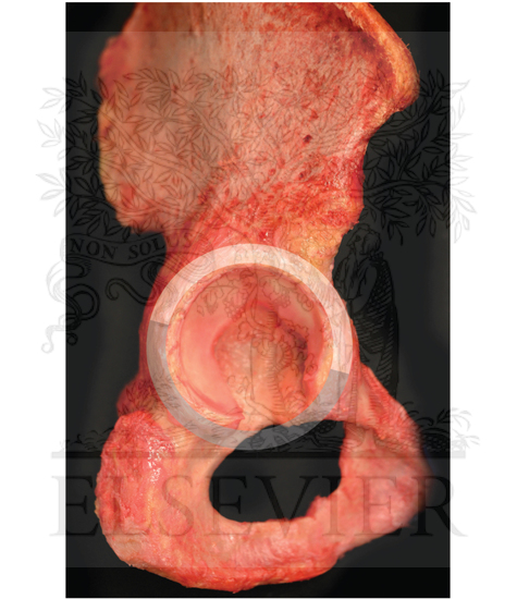 Cadaveric image of a right hip showing the most relevant osseous landmarks in hip arthroscopy and their position using a superimposed clock