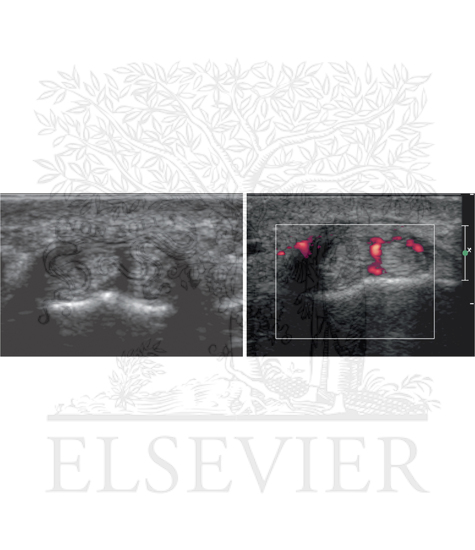 Watermarked preview of unlabeled image: De Quervain tenosynovitis