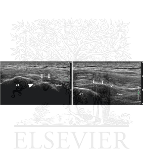 Gluteus medius tendinopathy