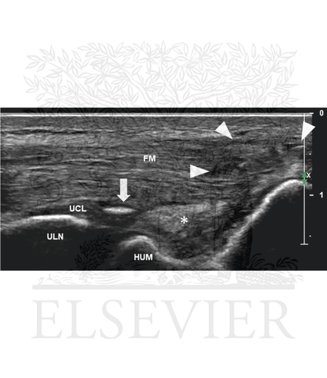 Watermarked preview of unlabeled image: Ulnar collateral ligament sprain