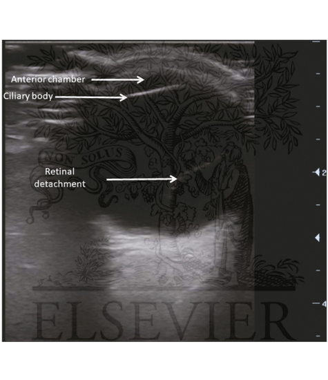 Retinal detachment appears as a linear hyperechoic structure within the anechoic vitreous body, fixed to the posterior globe