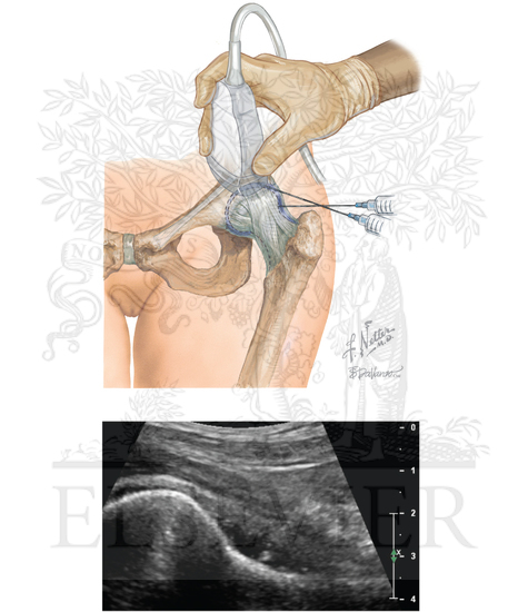 Watermarked preview of unlabeled image: Hip joint injection: anterior approach