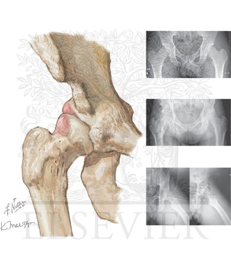 Watermarked preview of unlabeled image: Femoroacetabular impingement