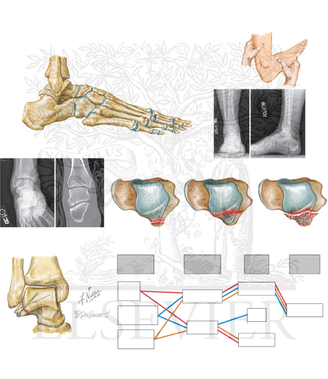 Fracture of lateral process of talus