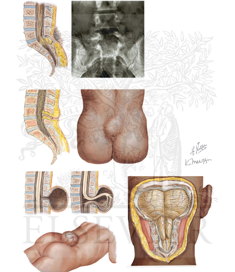 SPINAL DYSRAPHISM
