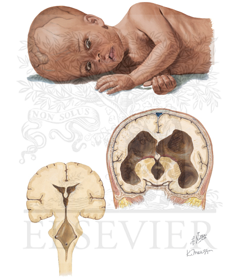 HYDROCEPHALUS