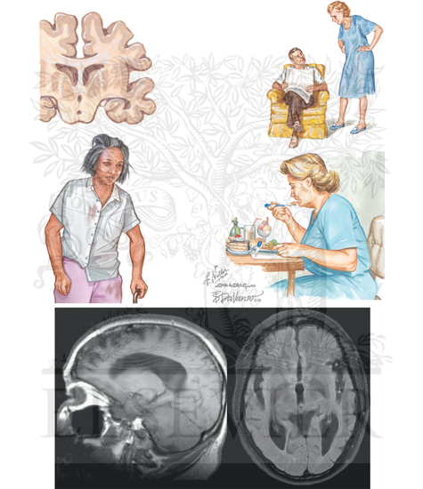 FRONTOTEMPORAL DEMENTIA