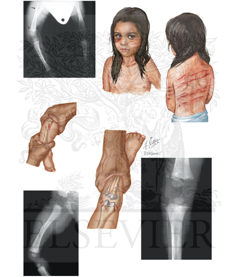 CHILD ABUSE: FRACTURES IN ABUSED CHILDREN