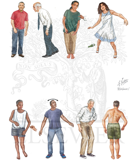 GAIT DISORDERS: DIFFERENTIAL DIAGNOSIS