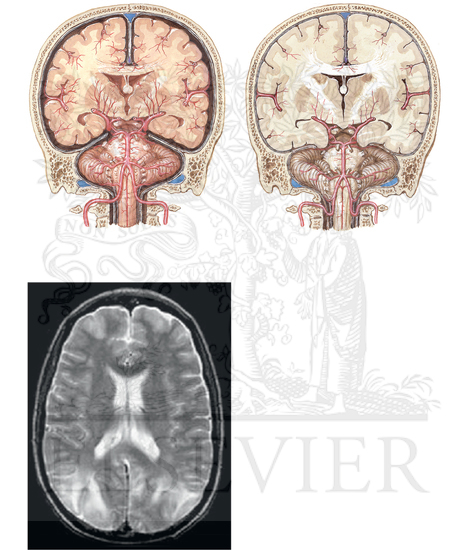 Watermarked preview of unlabeled image: HYPERTENSIVE ENCEPHALOPATHY