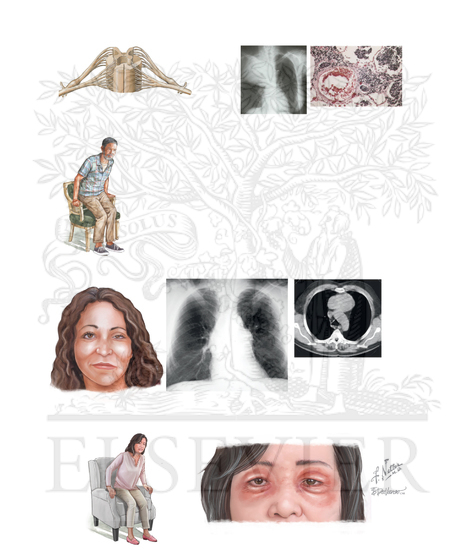 Watermarked preview of unlabeled image: Autoimmune Neurologic Syndromes: Central and Peripheral Nervous System Manifestations: PERIPHERAL MOTOR SENSORY UNIT - PARANEOPLASTIC