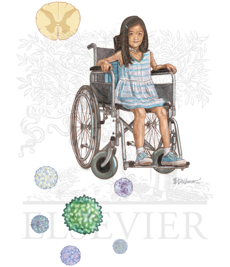 Watermarked preview of unlabeled image: ACUTE FLACCID PARALYSIS