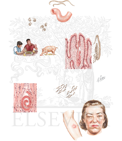 Watermarked preview of unlabeled image: PARASITIC INFECTIONS: TRICHINOSIS (TRICHINELLOSIS)