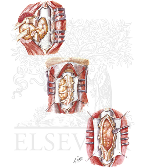 Watermarked preview of unlabeled image: CLASSIFICATION OF SPINAL TUMORS