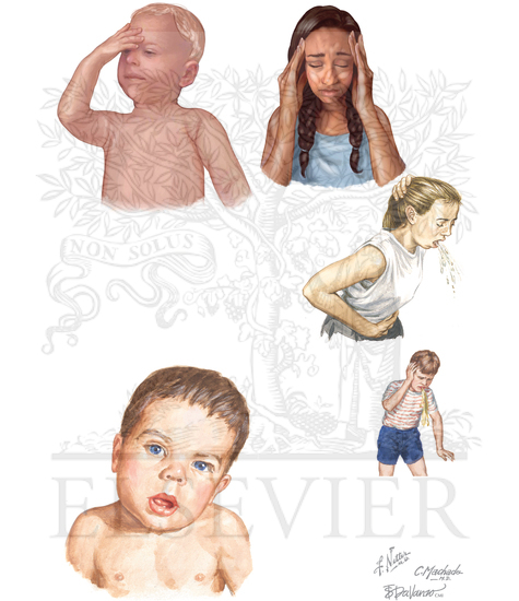 PEDIATRIC HEADACHE: Benign paroxysmal vertigo, Cyclic vomiting syndrome, Paroxysmal torticollis of infancy