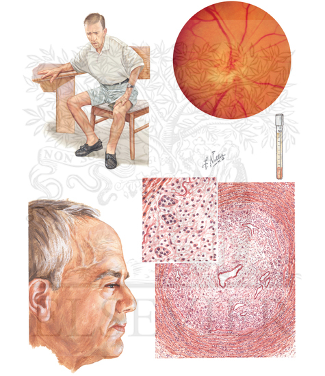 GIANT CELL ARTERITIS