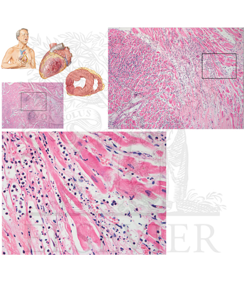 Watermarked preview of unlabeled image: Pathology of Muscle Tissue