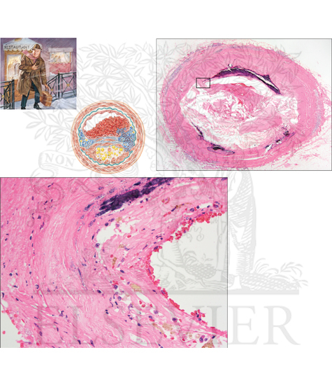 Watermarked preview of unlabeled image: Pathology of Cardiovascular System