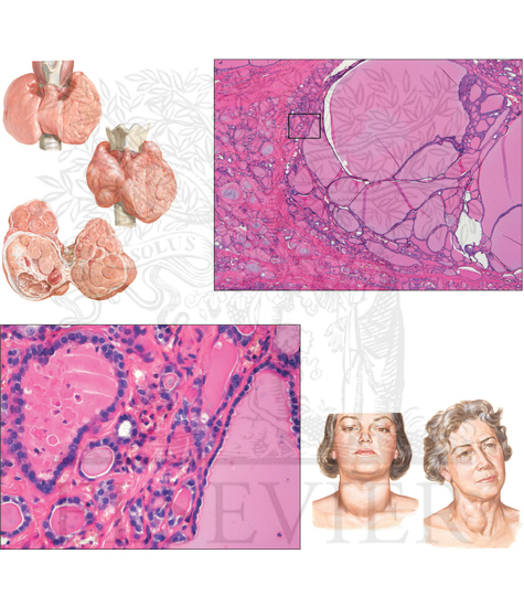 Pathology of Endocrine System